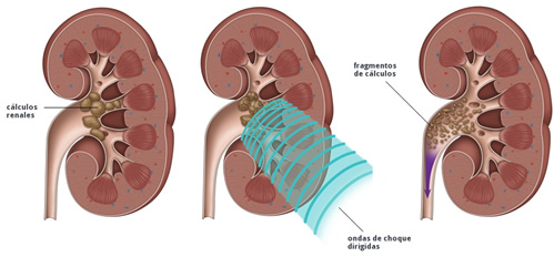 LITOTRICIA EXTRACORPOREA